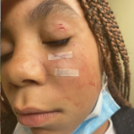 一个小黑人女孩的脸部特写，显示她被狗咬伤