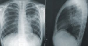 一组肺的两张x光片，一张正面一张侧面。