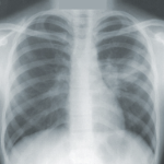 一张肺部的X光片