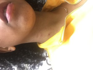 一个穿黄色衬衫的黑人妇女脖子上的抓痕