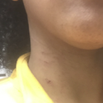 一个年轻黑人妇女脖子上的抓痕的特写